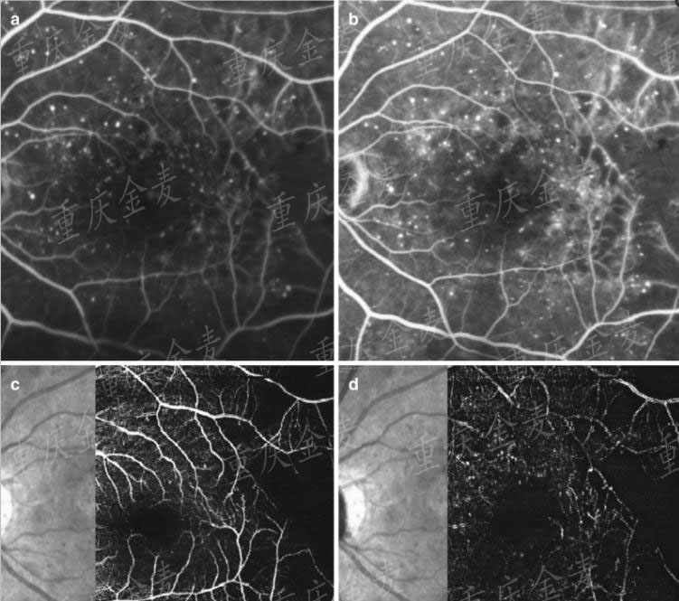熒光素眼底血管造影.jpg
